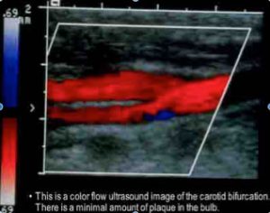 An ultrasound result