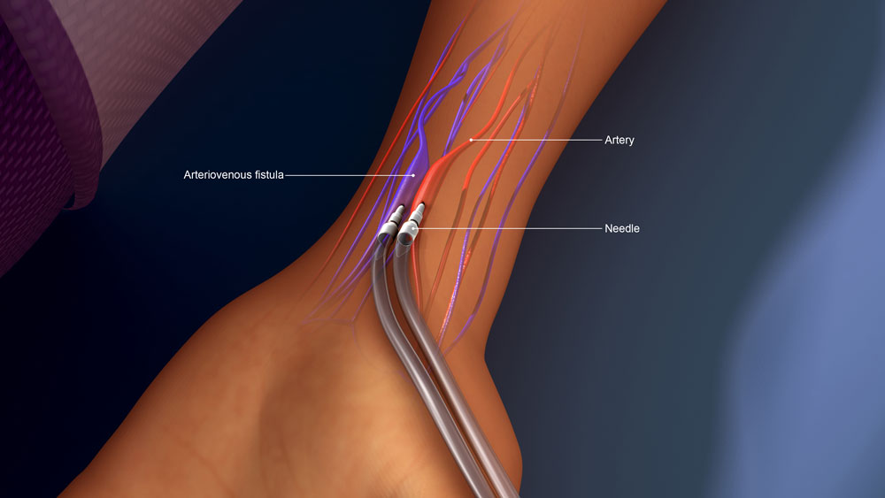 Dialysis Access Care - TCVCG